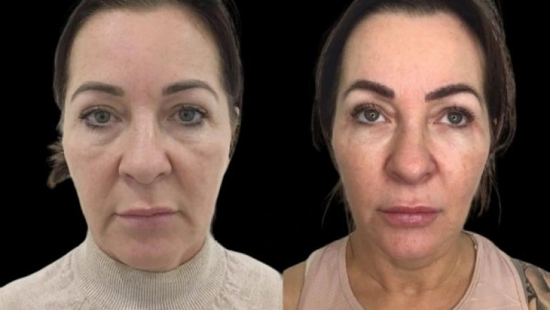 Frame Your Beauty with the Best Plastic Surgeon in dubai and Profhilo