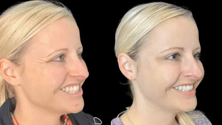 Redefine Your Look with the Best Plastic Surgeon in Dubai for Botox