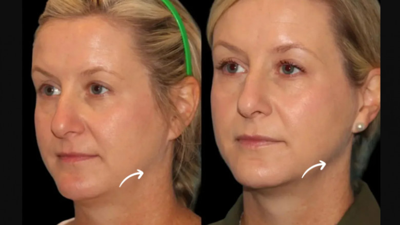 Best Doctors in Dubai Discuss How Often You Need Sculptra Fillers Sessions