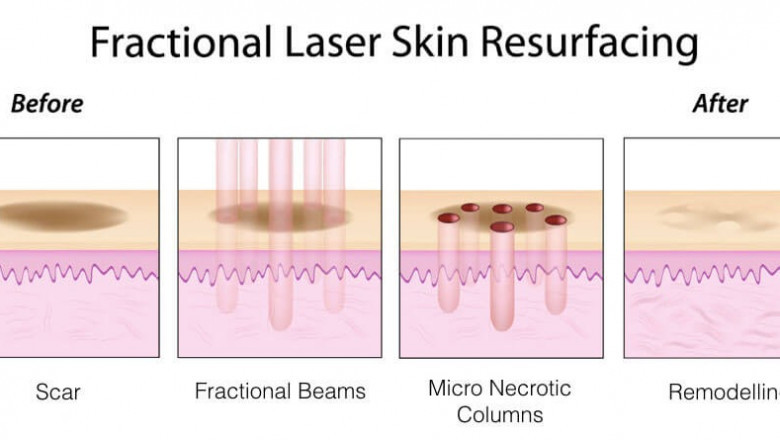 Rejuvenate and Renew: All About Fractional Resurfacing Treatment in Delhi