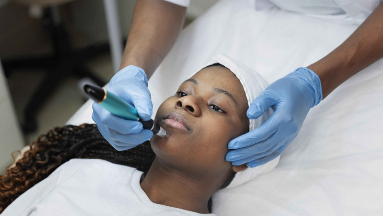 Step-by-Step Guide to Laser Hair Removal in Mississauga