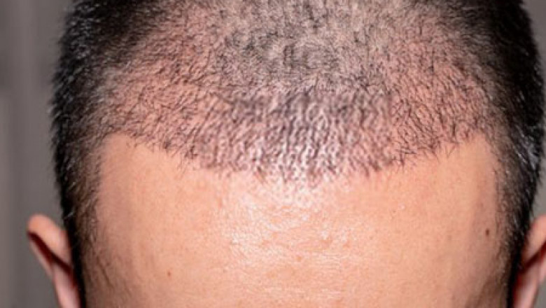 Rediscover Yourself with Hair Transplant in Chennai