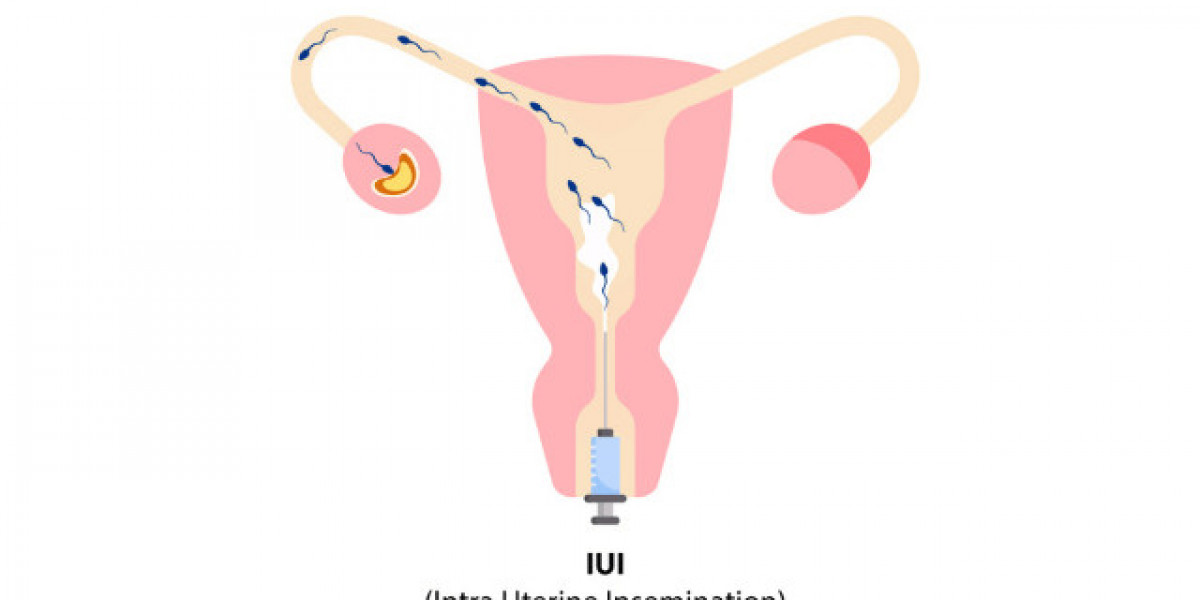 Guide to IUI Treatment in Lahore Australian Concept Infertility Center